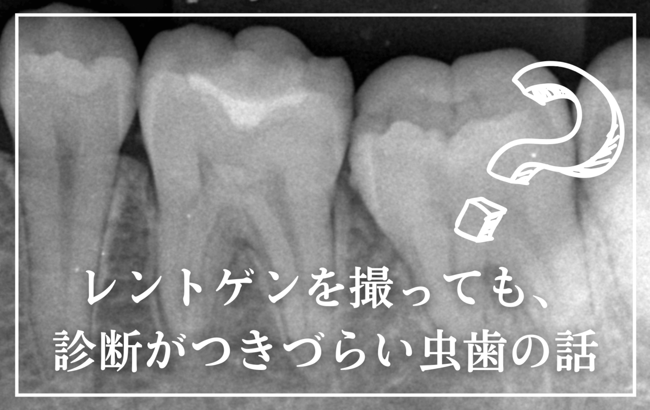 高円寺駅南口徒歩2分の歯医者、高円寺PAL歯科医院のレントゲンを撮っても、診断がつきづらい虫歯の話