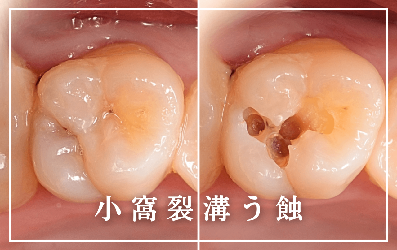 高円寺駅南口徒歩2分の歯医者、高円寺PAL歯科医院の他の歯医者さんで、小窩裂溝う蝕