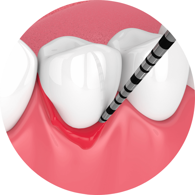 高円寺駅南口徒歩2分の歯医者、高円寺PAL歯科医院の歯周病治療