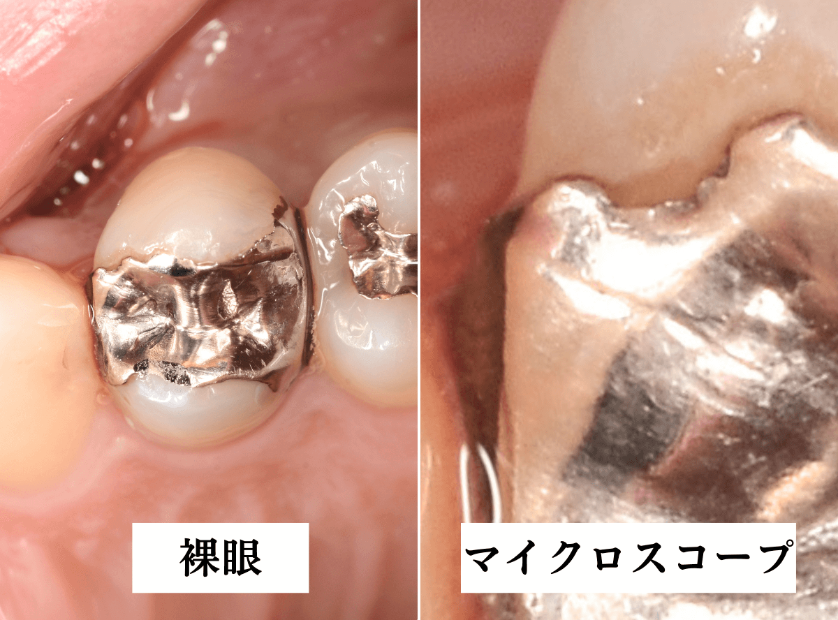 高円寺駅南口徒歩2分の歯医者、高円寺PAL歯科医院のマイクロスコープ診療