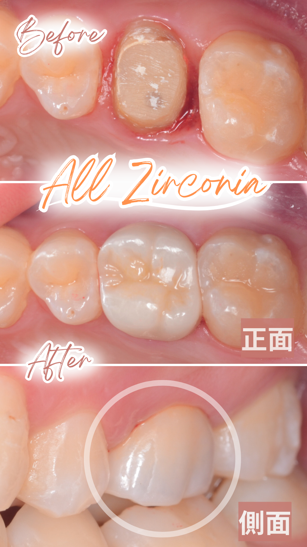 高円寺駅南口徒歩2分の歯医者、高円寺PAL歯科医院のセラミック治療