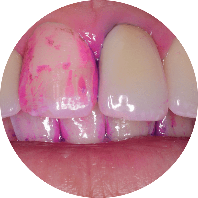 高円寺駅南口徒歩2分の歯医者、高円寺PAL歯科医院の歯周病治療