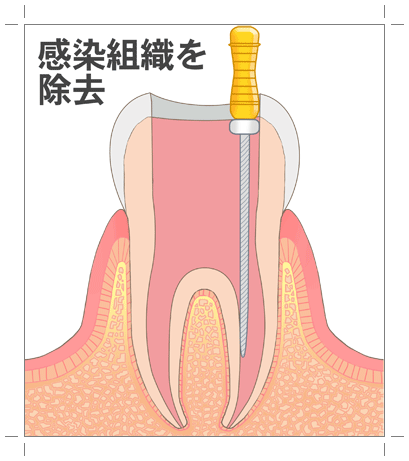 高円寺駅南口徒歩2分の歯医者、高円寺PAL歯科医院の根管治療の流れ