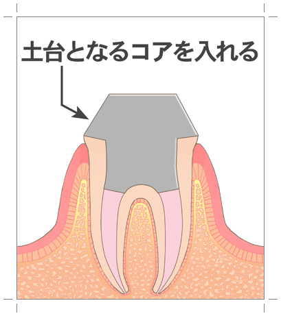 高円寺駅南口徒歩2分の歯医者、高円寺PAL歯科医院の根管治療の流れ